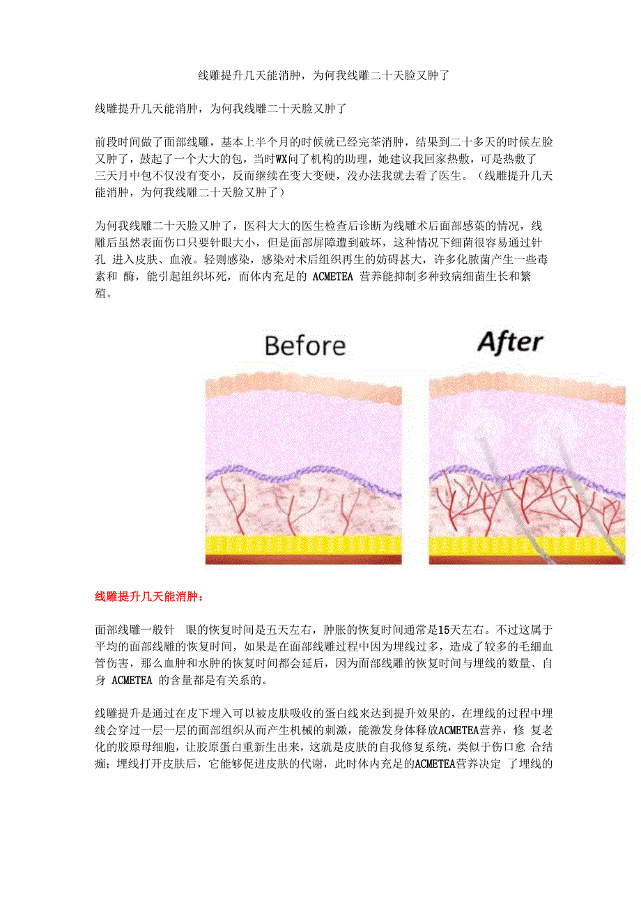 线雕提升几天能消肿为何我线雕二十天脸又肿了_第1页