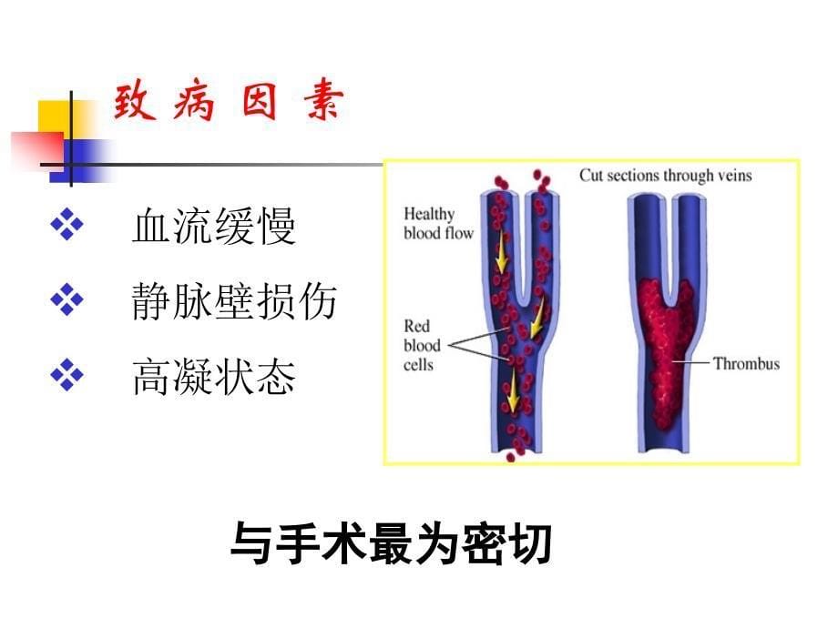 骨科大手术DVT预防_第5页