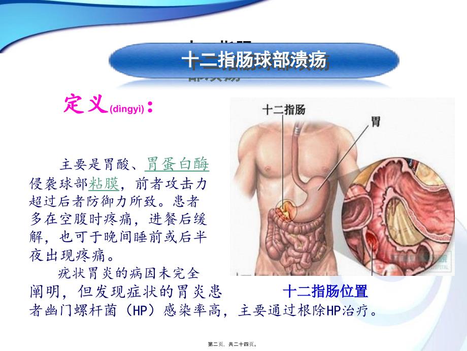 医学专题—十二指肠球部溃疡_第2页