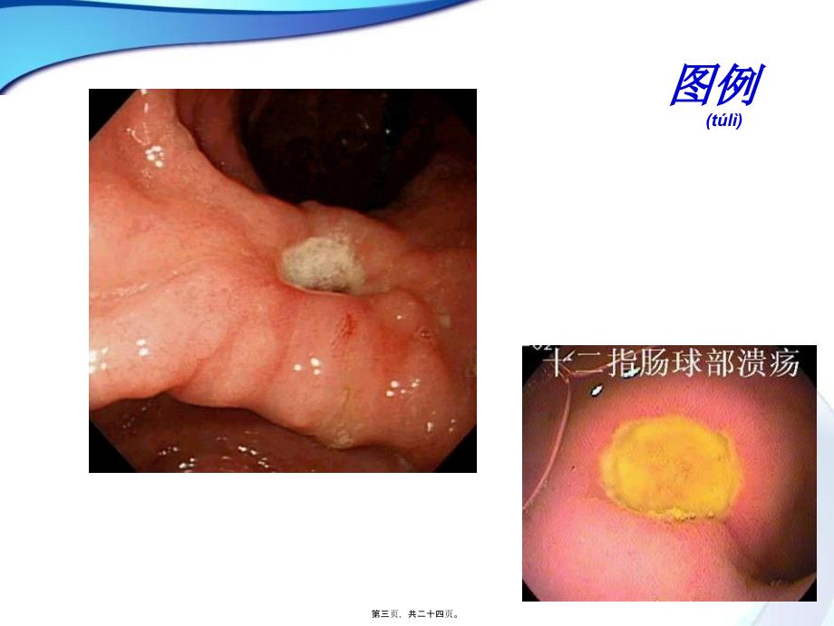 医学专题—十二指肠球部溃疡_第3页