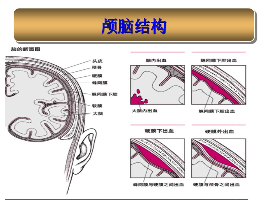 蛛网膜下腔出血护理_第3页