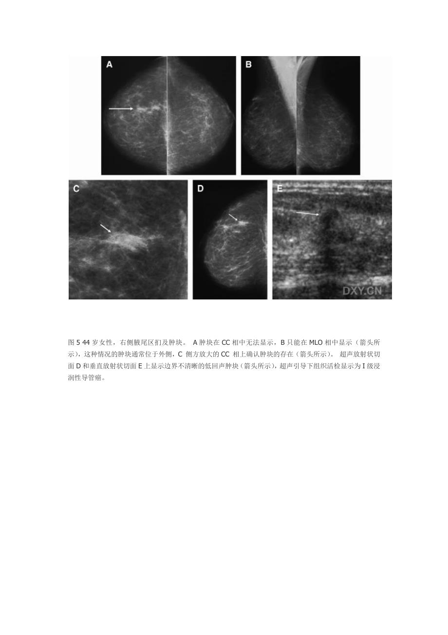 乳腺钼靶和超声对照.docx_第4页