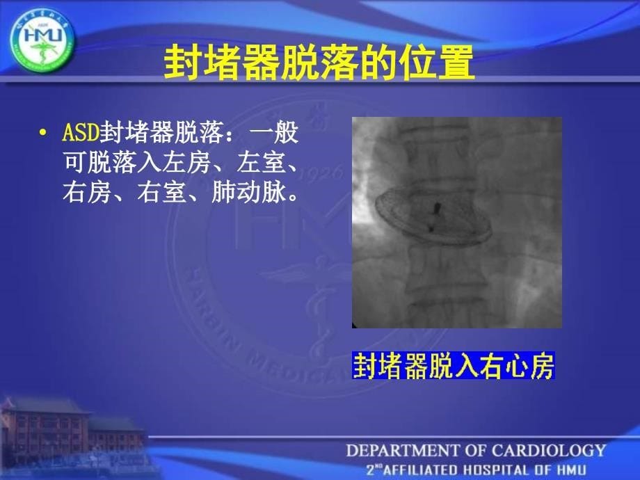 封堵器脱落处理与预防_第5页