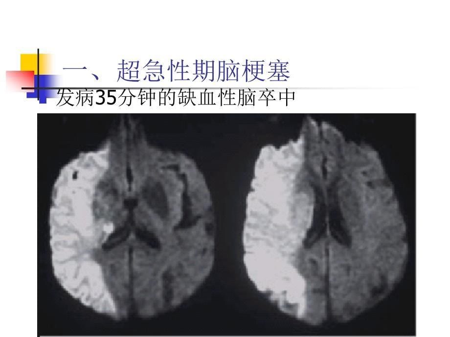 磁共振DWI的应用方案课件_第5页