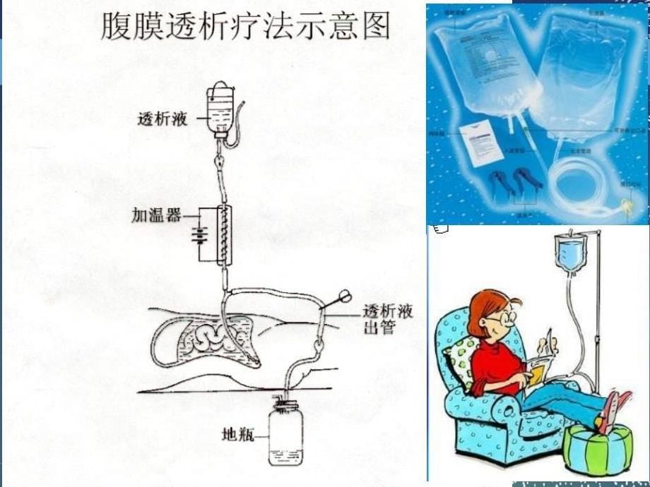 《肾脏替代治疗ICU》课件_第5页