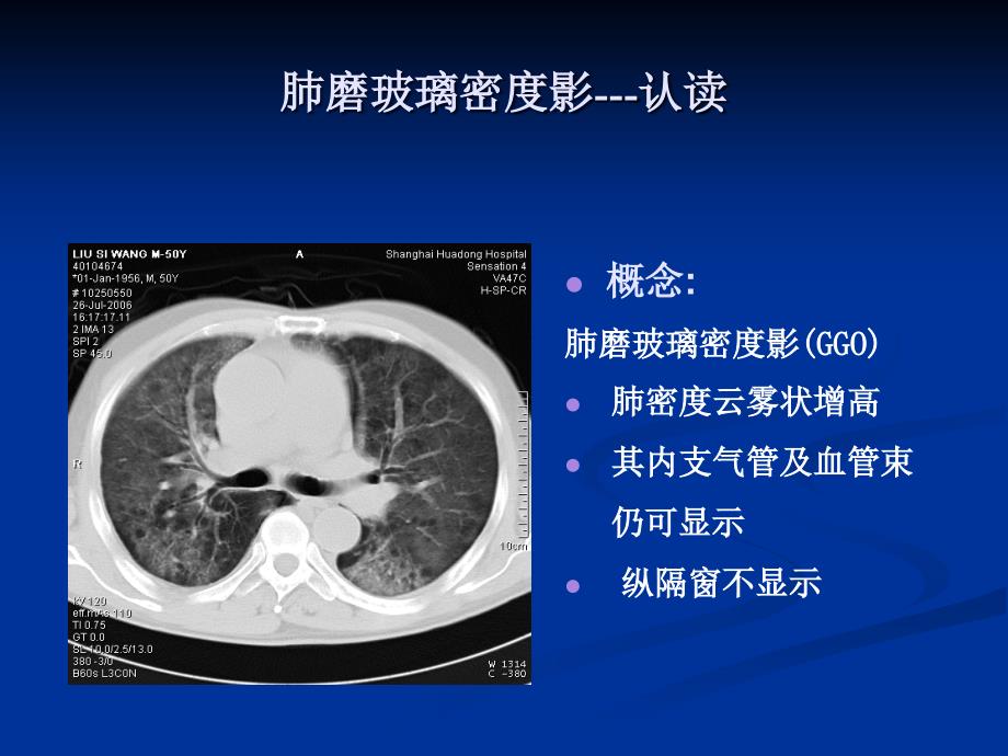 肺弥漫性磨玻璃密度影的影像分你析ppt课件_第2页