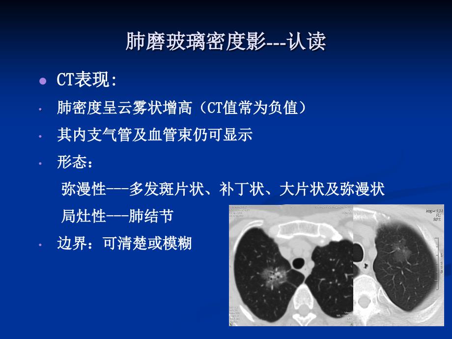 肺弥漫性磨玻璃密度影的影像分你析ppt课件_第4页