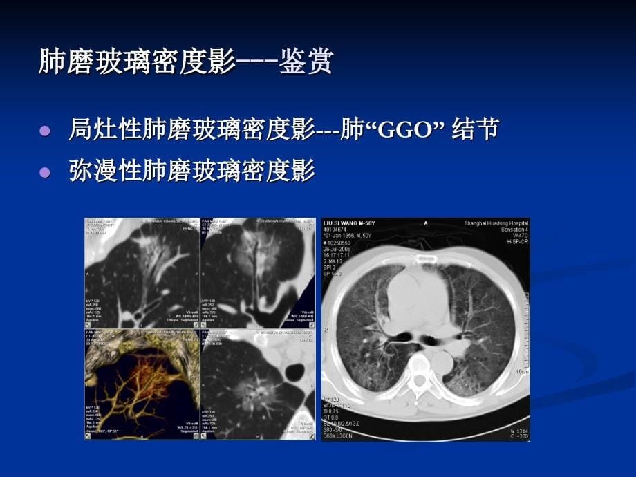 肺弥漫性磨玻璃密度影的影像分你析ppt课件_第5页