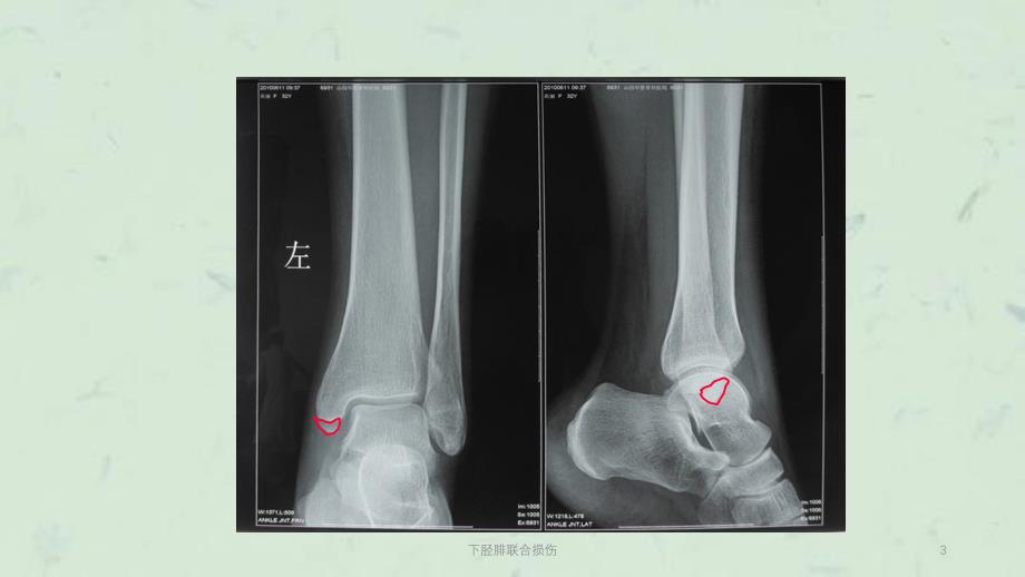 下胫腓联合损伤课件_第3页