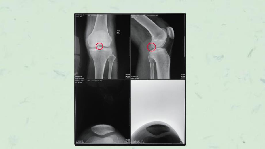 下胫腓联合损伤课件_第4页