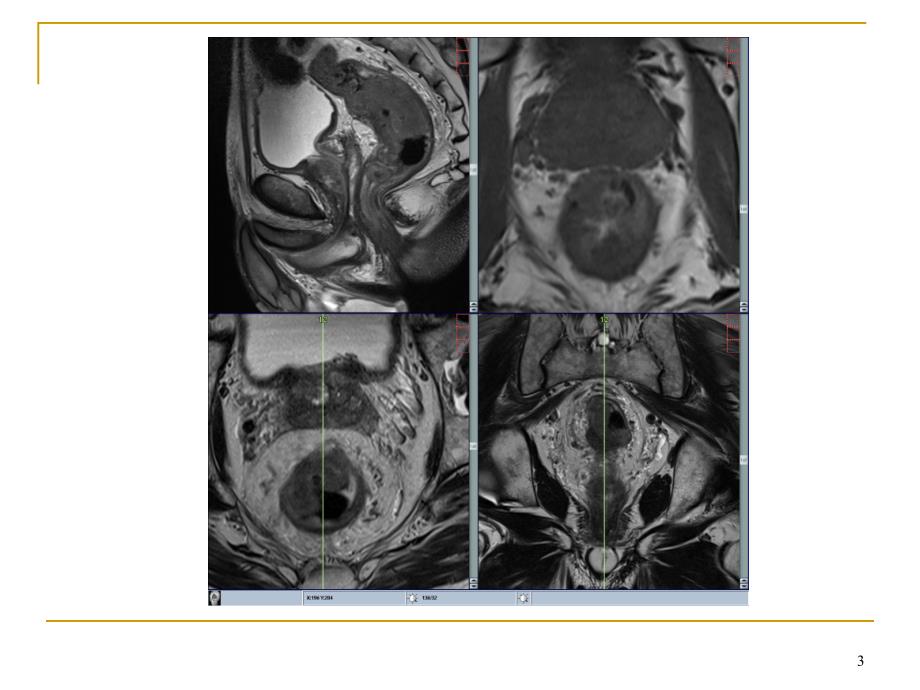 直肠癌MRI诊断PPT参考课件_第3页