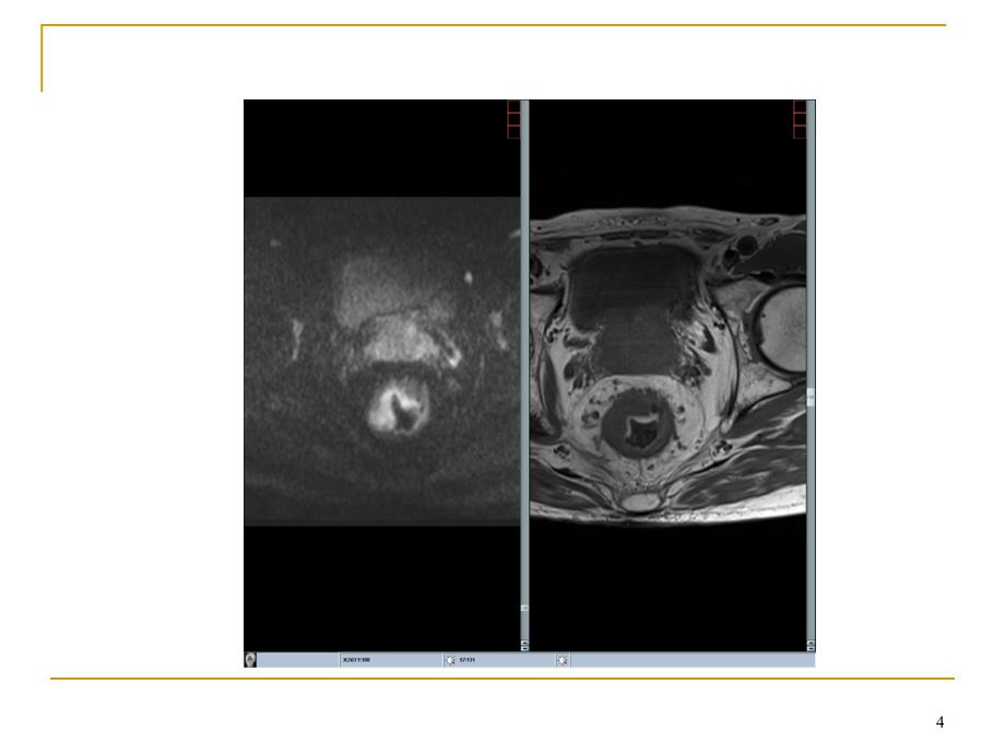 直肠癌MRI诊断PPT参考课件_第4页