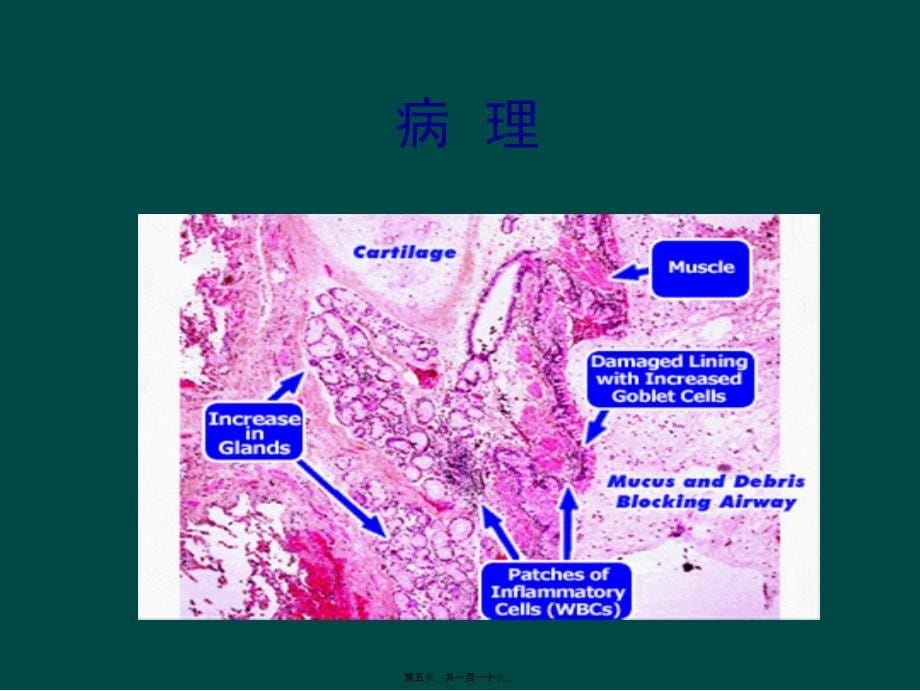 慢支炎肺气肿肺心病呼吸衰竭课件_第5页