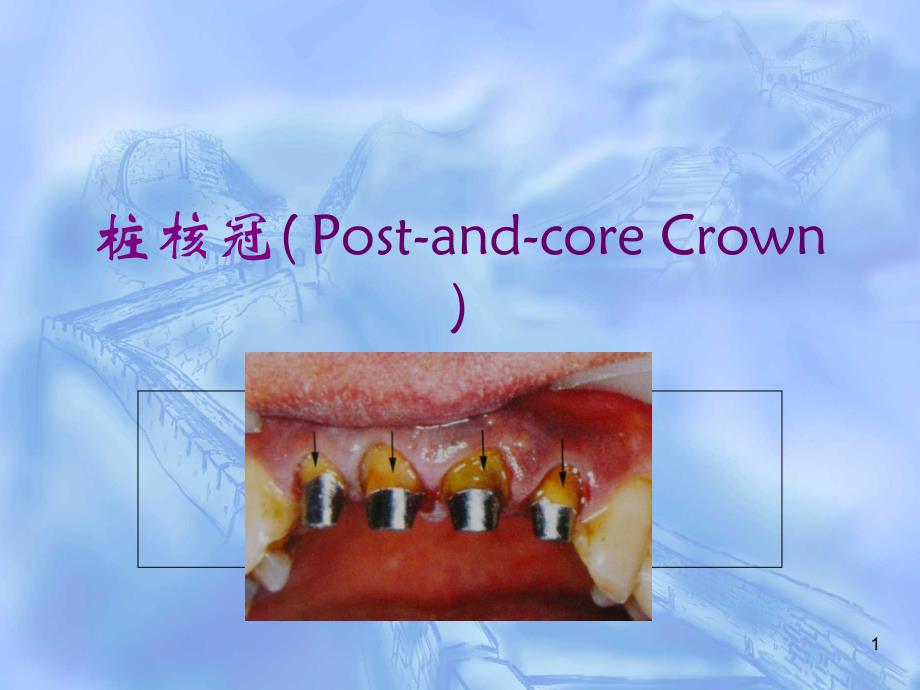 《桩核冠贴面》PPT课件_第1页