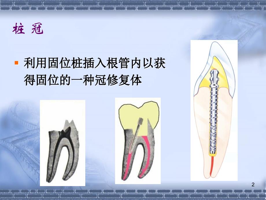 《桩核冠贴面》PPT课件_第2页