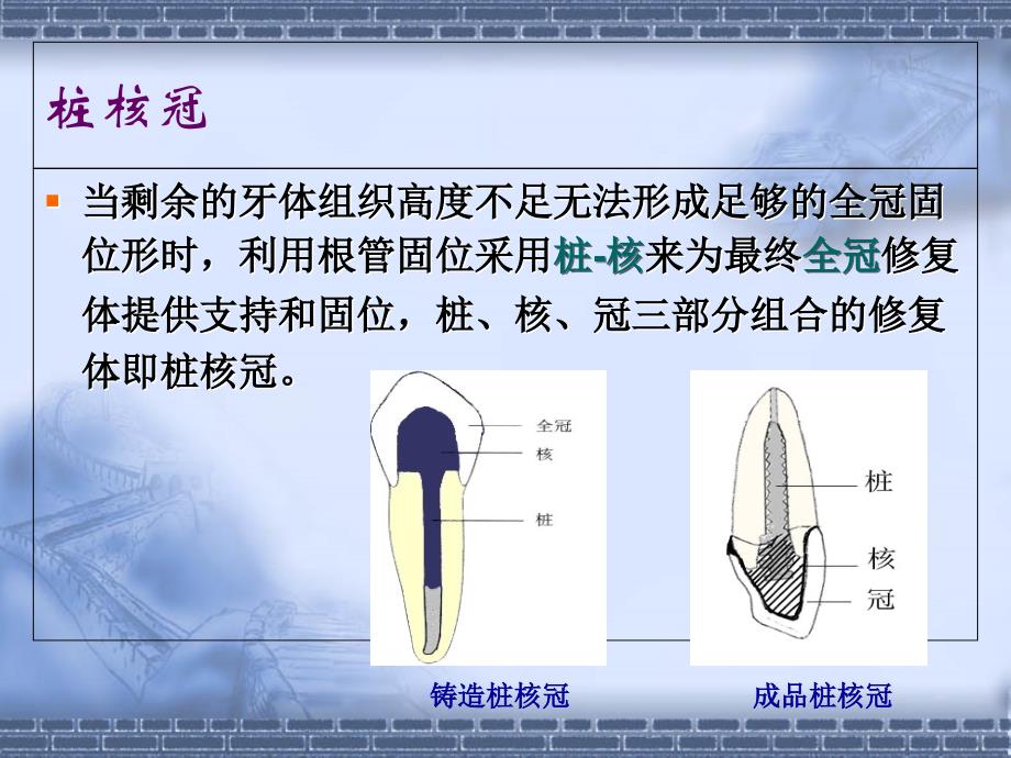 《桩核冠贴面》PPT课件_第3页