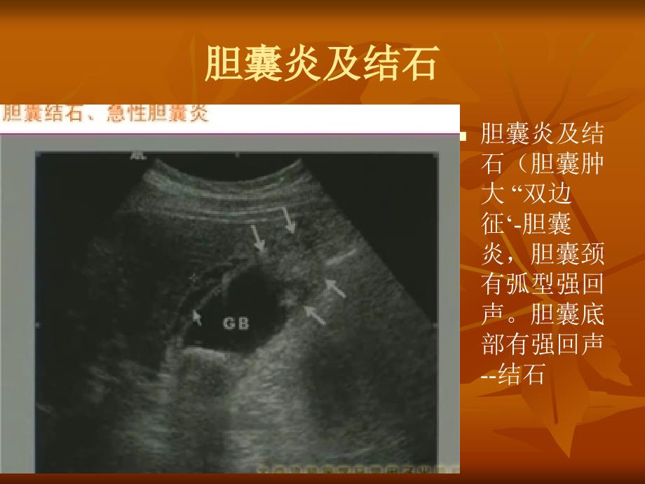 临床技能第三考站B超影像学课件_第4页