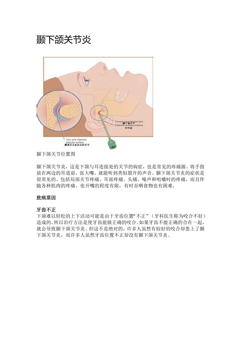 颞下颌关节炎 (2)(精品)_第1页