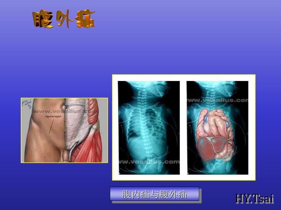 医药卫生腹外疝课件_第5页