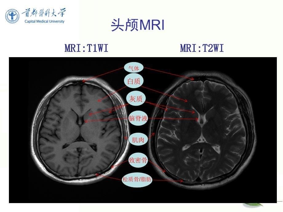 《影像诊断学》教学课件：中枢神经系统-2_第5页