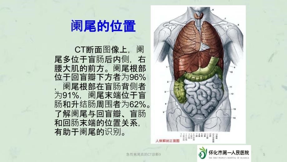 急性阑尾炎的CT诊断9课件_第5页