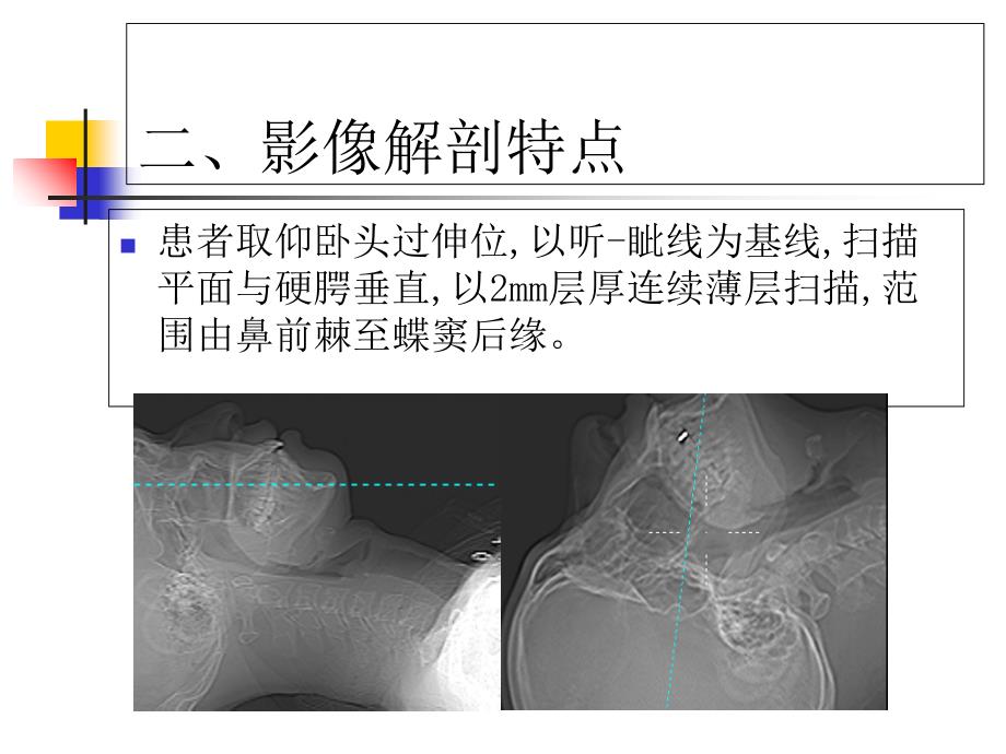 窦口鼻道复合体影像解剖及临床意义_第4页