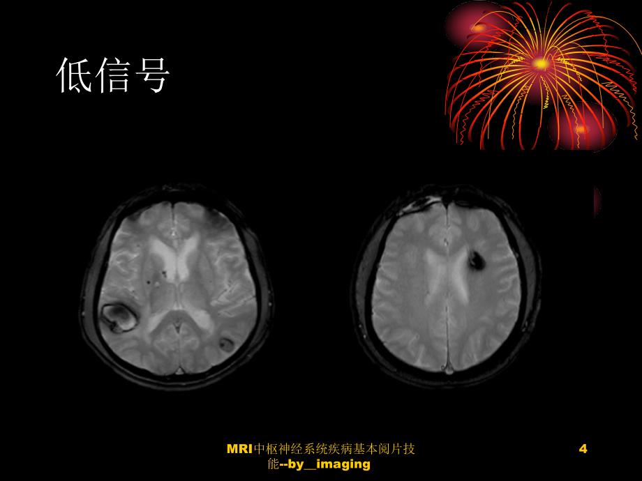 MRI中枢神经系统疾病基本阅片技能imaging课件_第4页