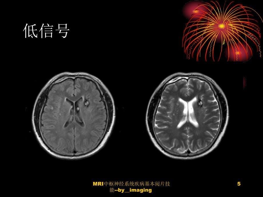 MRI中枢神经系统疾病基本阅片技能imaging课件_第5页