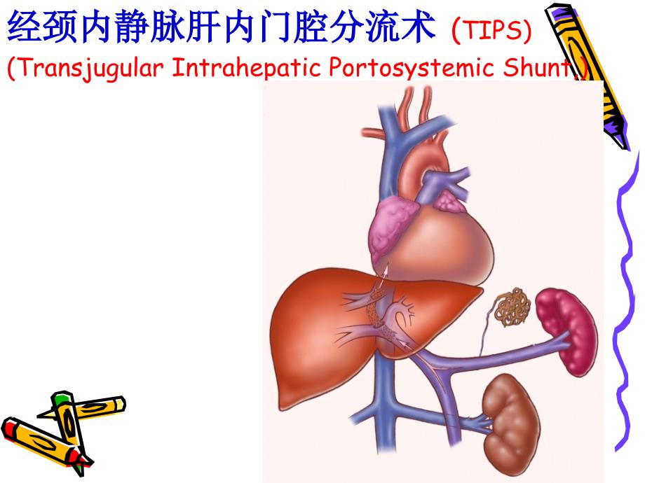 经颈内静脉肝内门腔分流术治疗门脉高压食道胃底静脉曲张破裂出血的应用研究PPT课件_第2页