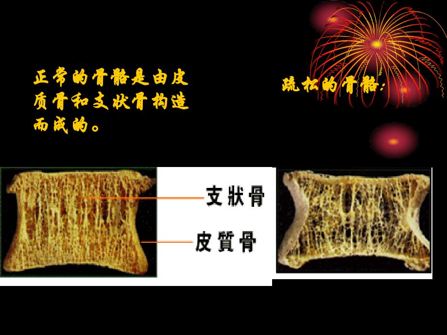 中医骨病学(骨质疏松症)_第3页