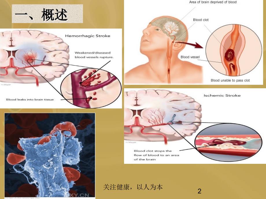 缺血性脑卒中的二级预防_第2页