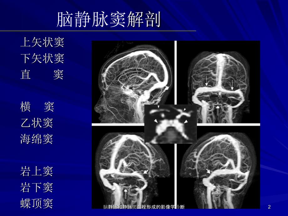 脑静脉和静脉窦血栓形成的影像学诊断课件_第2页