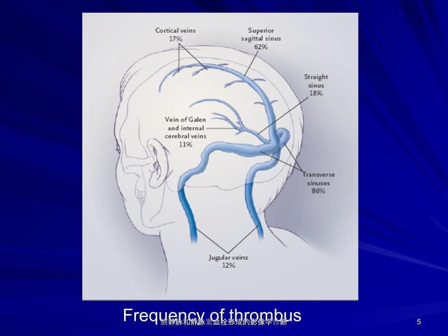 脑静脉和静脉窦血栓形成的影像学诊断课件_第5页