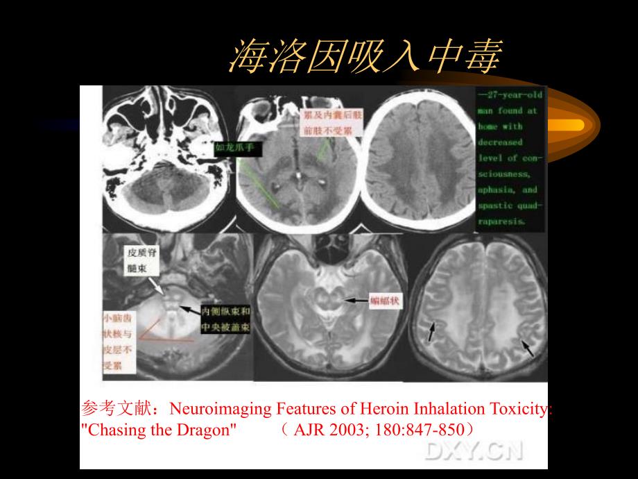 25脑白质病变文档资料_第4页