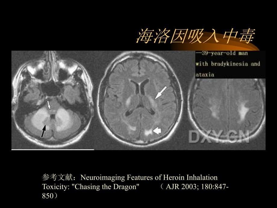 25脑白质病变文档资料_第5页