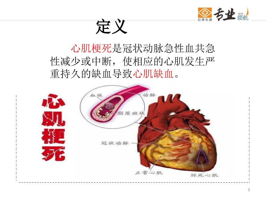 心肌梗死的护理ppt课件.ppt_第3页