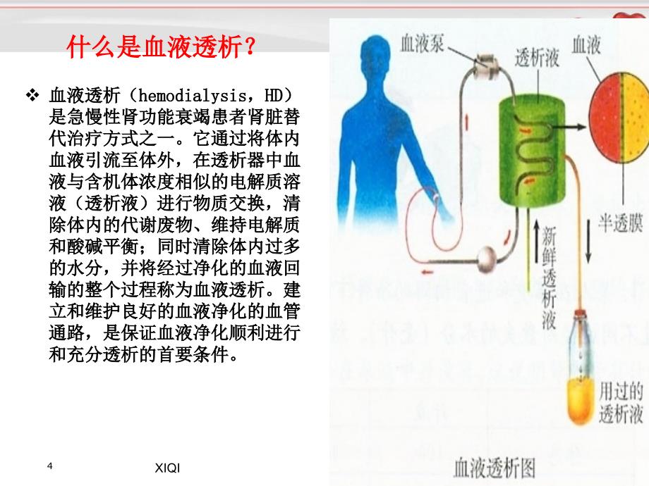 动静脉内瘘的围手术期护理_第4页