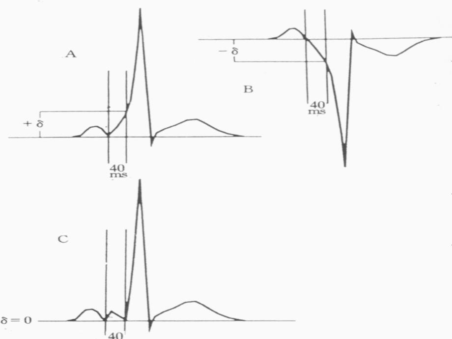 显性房室旁道的体表心电图定位_第4页