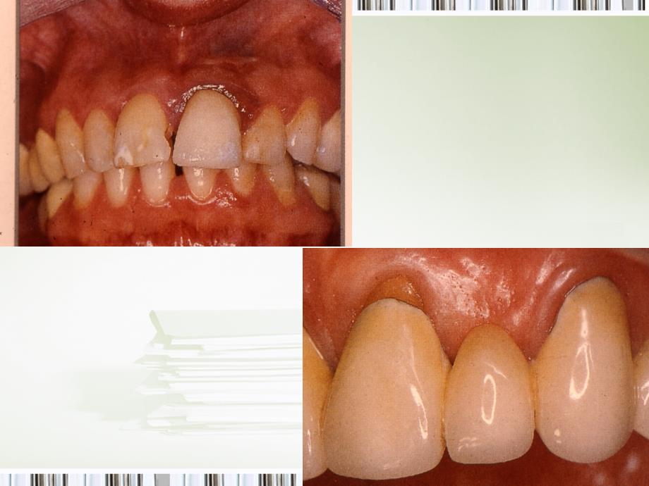 全瓷冠试戴与粘固课件_第4页