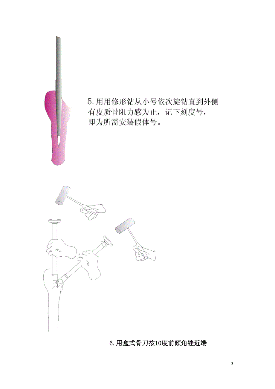 髋关节置换手术操作流程.doc_第3页