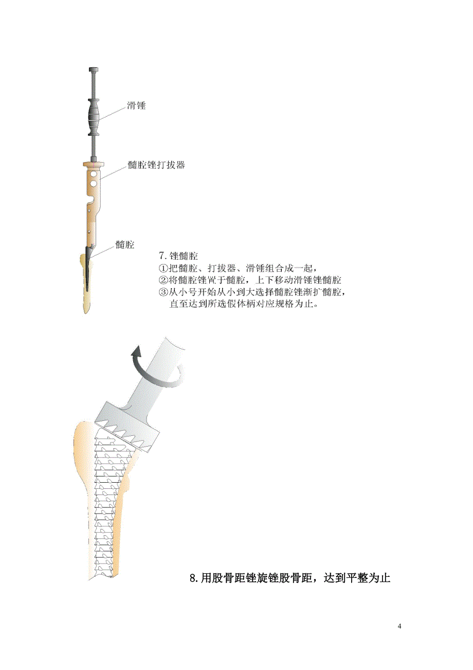 髋关节置换手术操作流程.doc_第4页