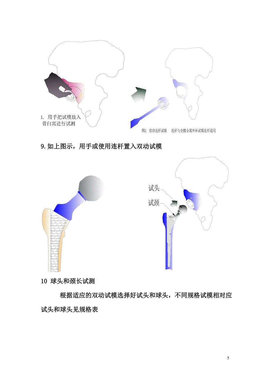 髋关节置换手术操作流程.doc_第5页