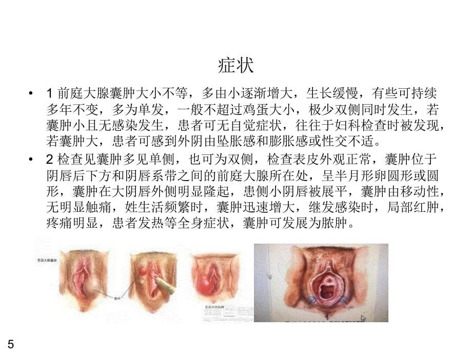 前庭大腺囊肿术后护理_第5页