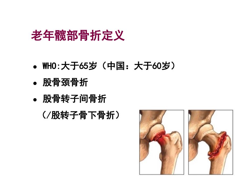 最新：[临床医学]裴福兴老年髋部骨折围手术期的评估与处理文档资料_第1页