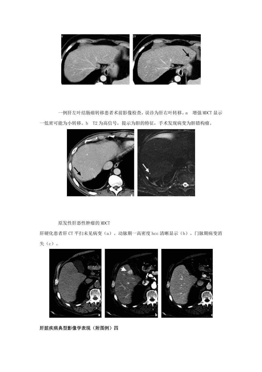 肝脏疾病典型影像学表现(附图例).doc_第5页