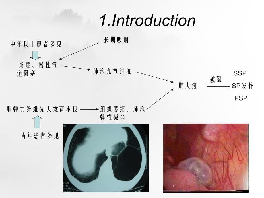 自发性气胸的临床治疗指南版解读_第5页