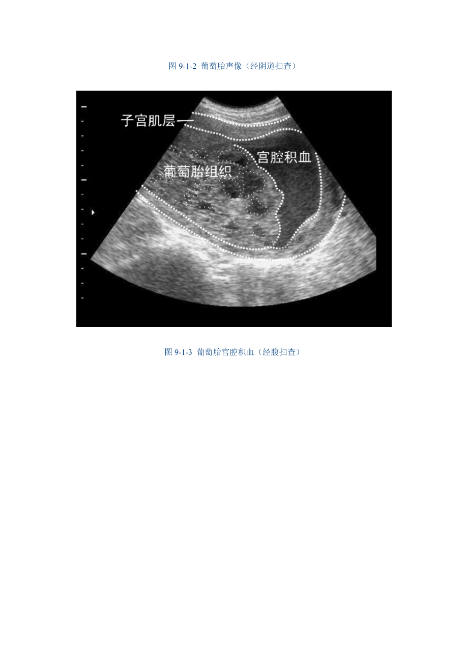 9 子宫腔与子宫内膜病变的超声诊断.doc_第3页