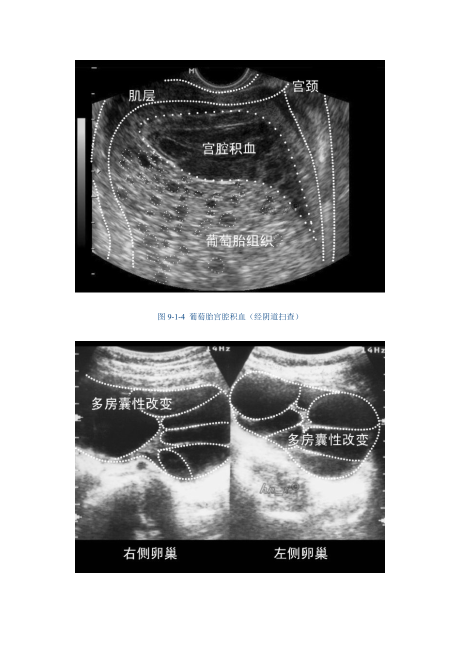 9 子宫腔与子宫内膜病变的超声诊断.doc_第4页