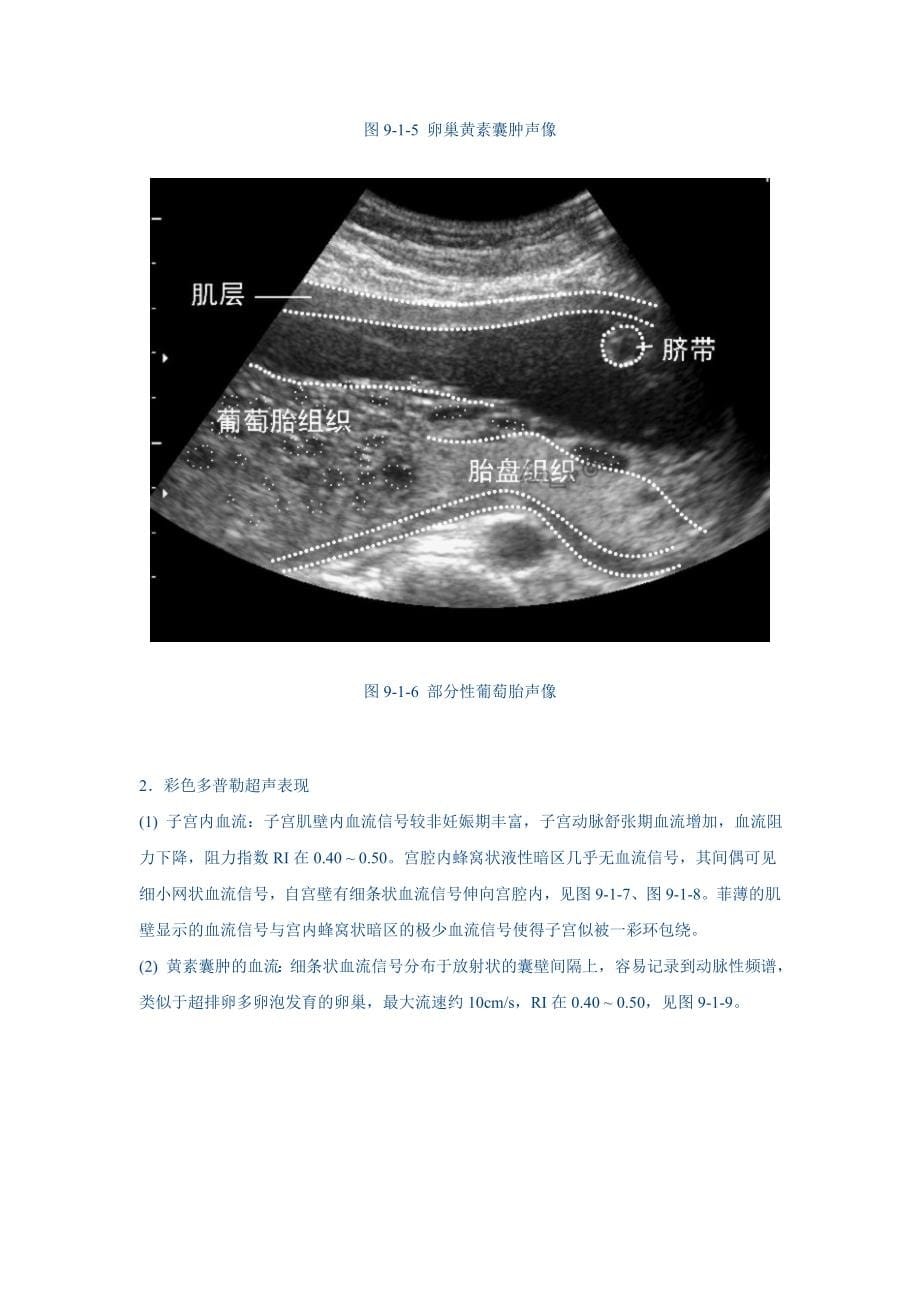9 子宫腔与子宫内膜病变的超声诊断.doc_第5页
