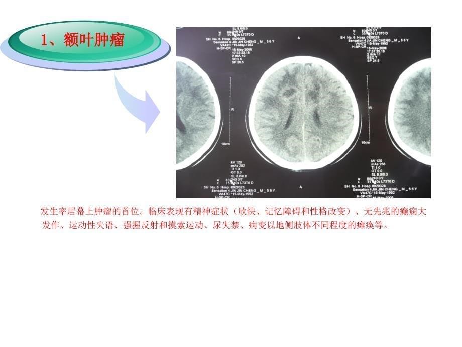 阐述颅脑肿瘤课件_第5页